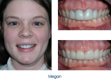 Cosmetic Veneers Before and After
