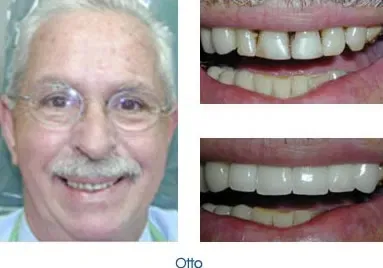 Man smile - Before and after of veneers
