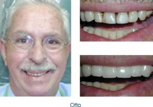 An older man with a mustache. The before close-up shows worn, slightly discolored upper teeth. The after close-up reveals a full set of bright, uniform white veneers on the upper arch