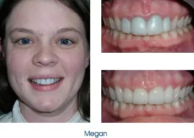 Before and after teeth repair