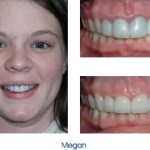 Before and after teeth repair