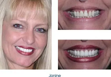 Before and after teeth repair