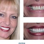 Before and after teeth repair