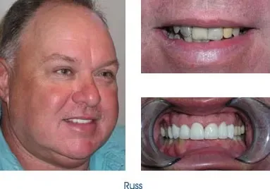 Before and after teeth repair