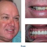 Before and after teeth repair