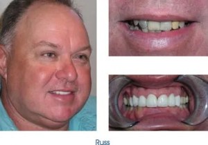 Before and after teeth repair