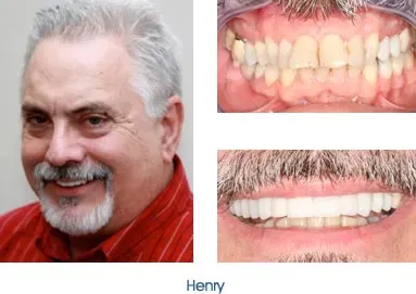Before and after teeth repair
