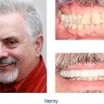 Before and after teeth repair