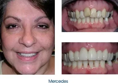 Before and after teeth repair