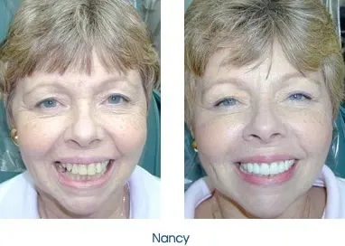 Before and after teeth repair