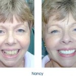 Before and after teeth repair