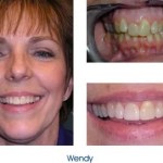 Before and after teeth repair
