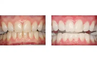 Before and after teeth repair