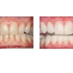 Before and after teeth repair