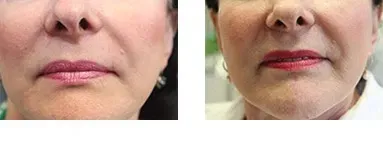 Before and after