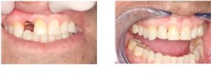 Before and after teeth repair