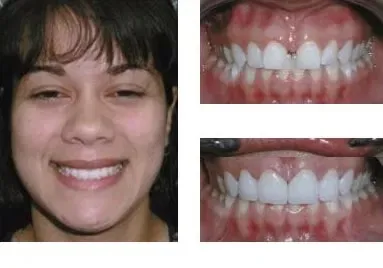 Before and after teeth repair