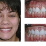 Before and after teeth repair