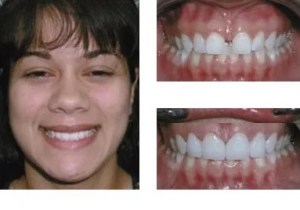 Before and after teeth repair
