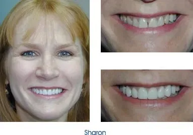 Before and after teeth repair