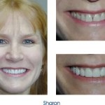Before and after teeth repair