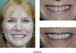 Before and after teeth repair
