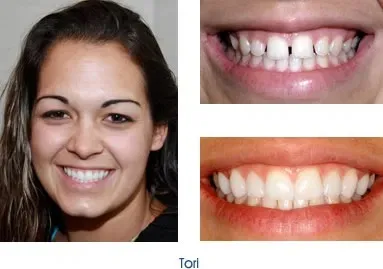 Before and after teeth repair