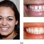 Before and after teeth repair
