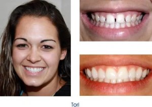 Before and after teeth repair