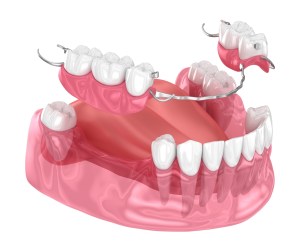 Model image of partial dentures